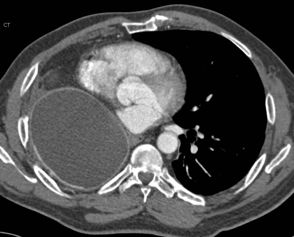 Tissue Expander in Right Pleural Space - CTisus CT Scan