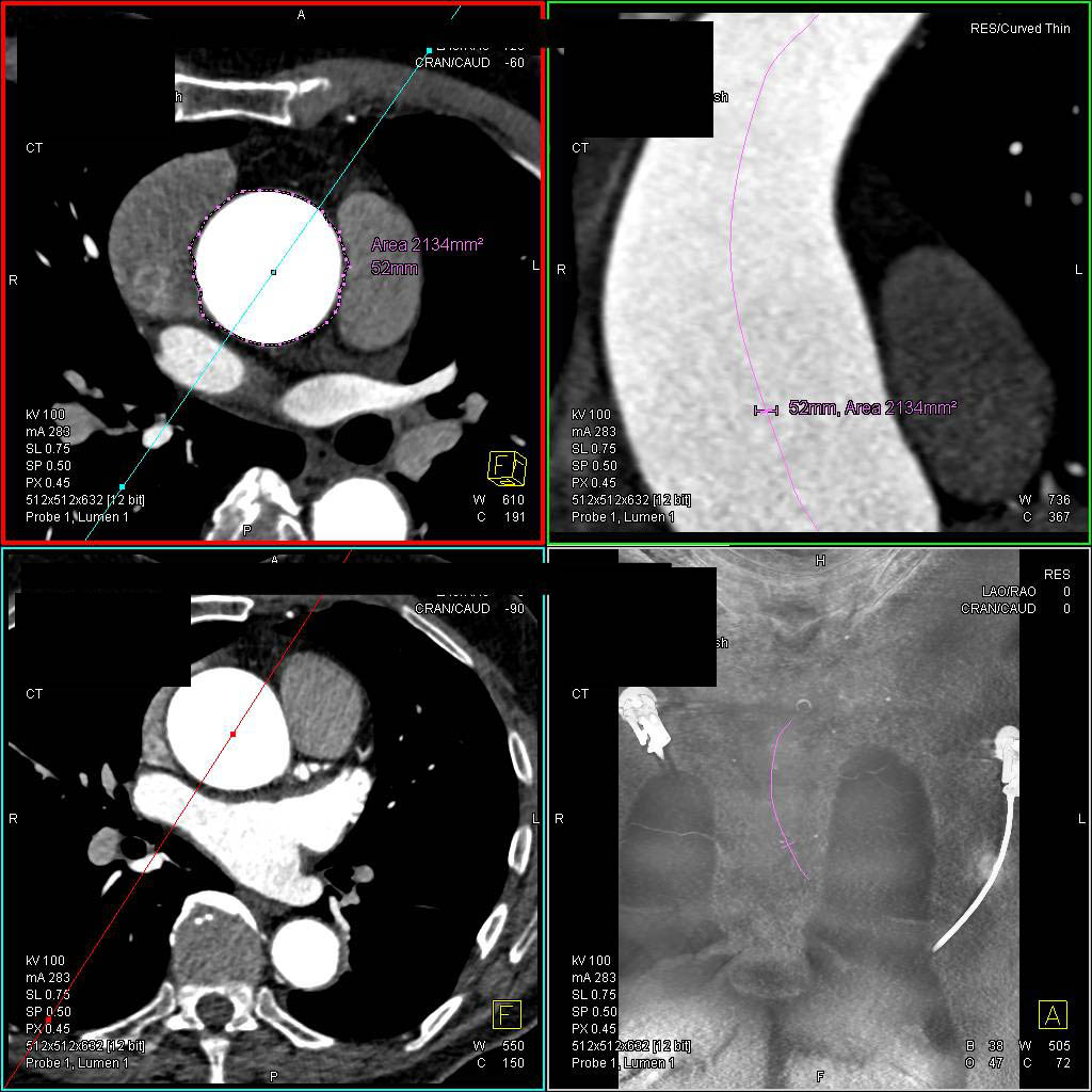 Dilated Ascending Aorta in a Marfan Patient with Center Line Measurement - CTisus CT Scan