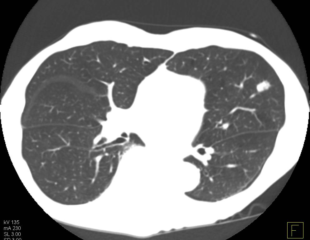 Bronchoalveolar Carcinoma (BAC) - CTisus CT Scan