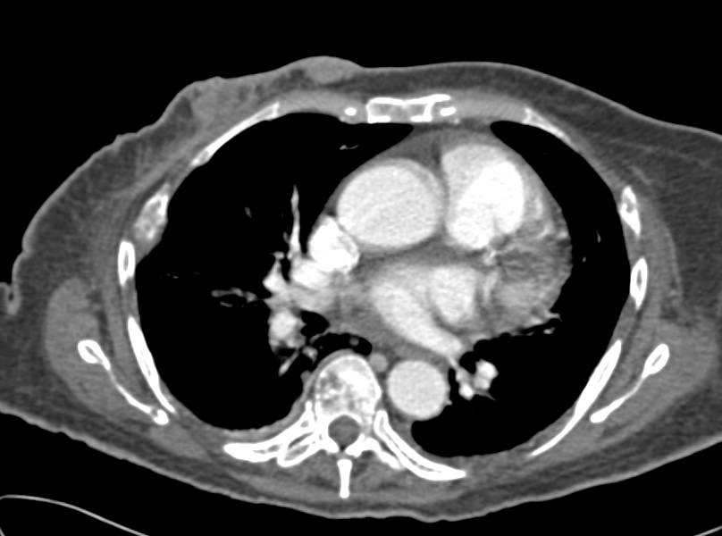 Breast Cancer with Multiple Sites of Metastases - CTisus CT Scan