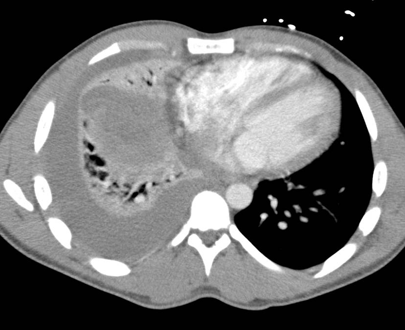 Liver Abscess Extends Into the Pleural Space and Becomes an Empyema - CTisus CT Scan