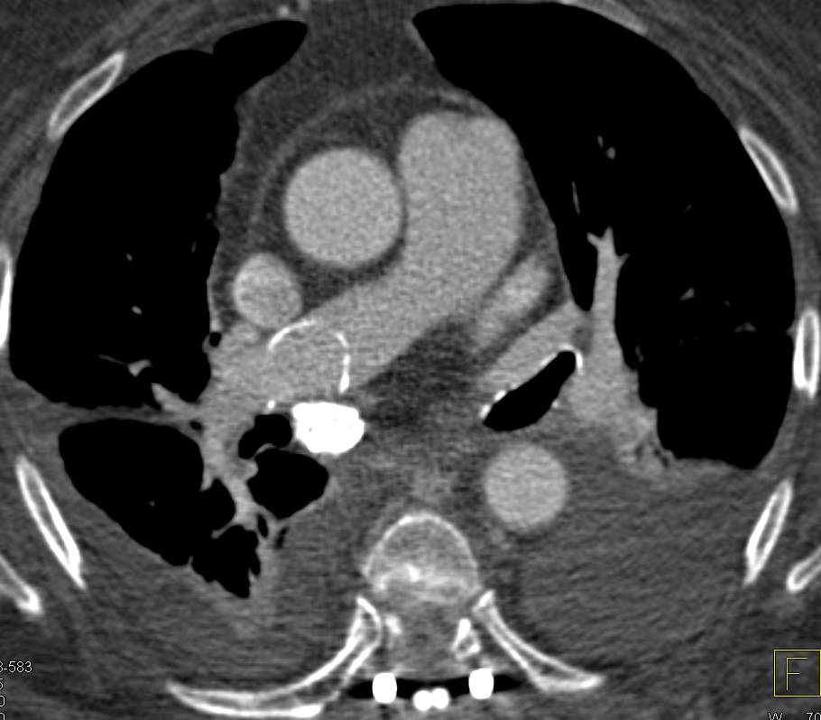 Foreign Body in Right Main Pulmonary Artery - CTisus CT Scan