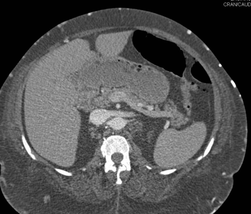 Superior Vena Cava (SVC) Stenosis with Stent in SVC and Extensive Collaterals in Abdominal and Chest Wall - CTisus CT Scan