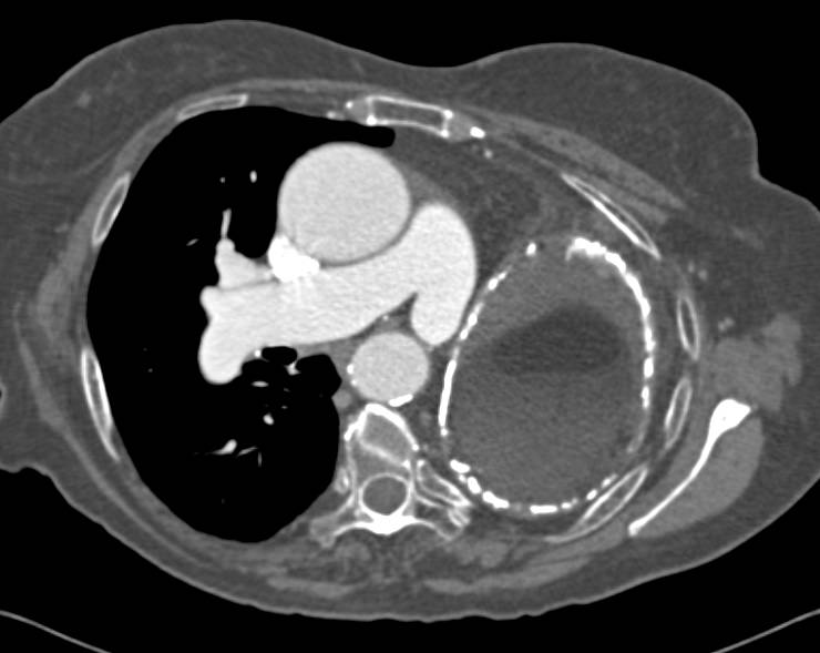 Chylothorax following Pneumonectomy - CTisus CT Scan
