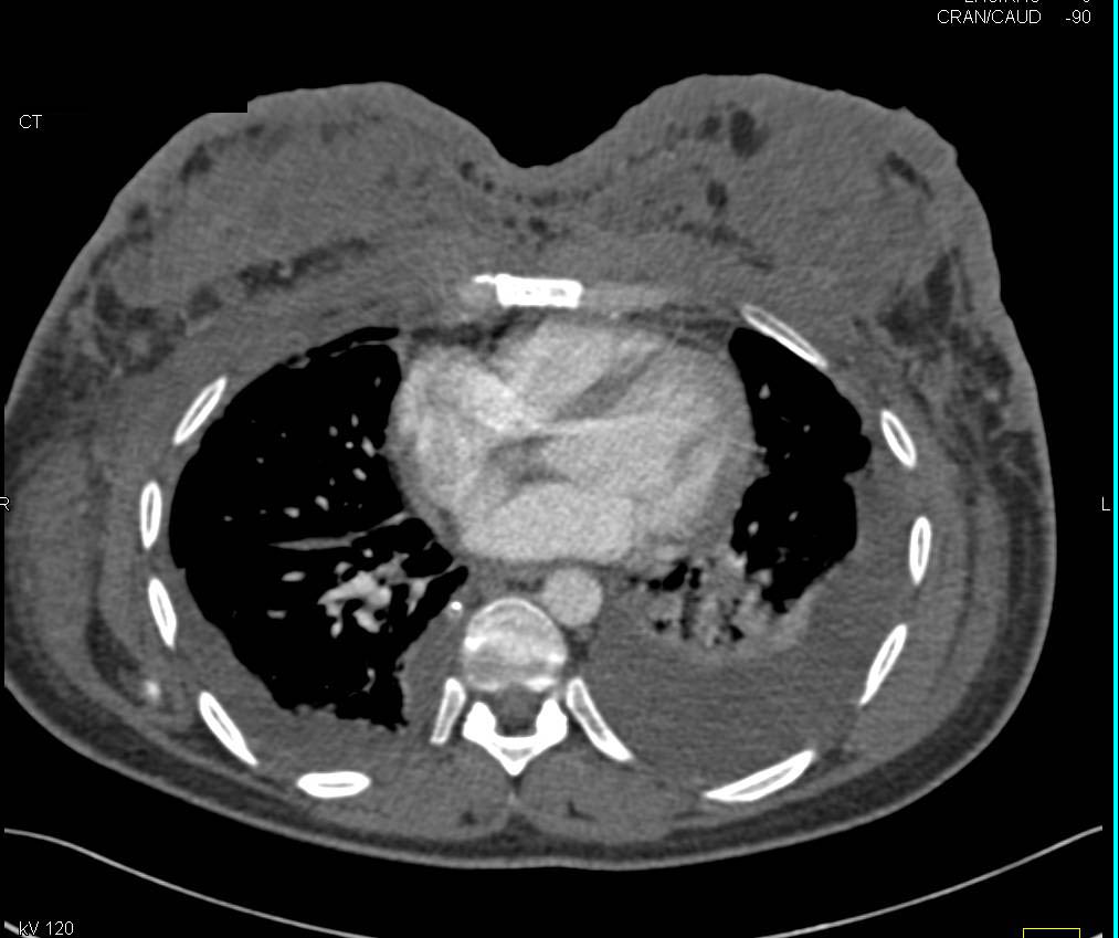 Infiltrating Bilateral Breast Carcinoma - CTisus CT Scan