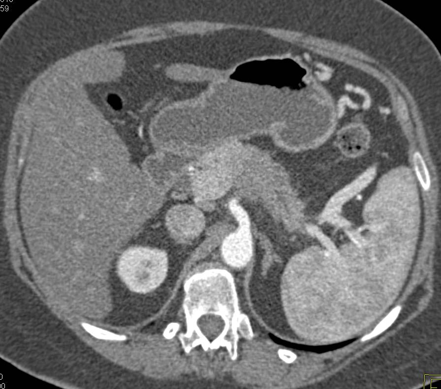 Incidental Left Breast Cancer Discovered While Staging a Pancreatic Tumor - CTisus CT Scan