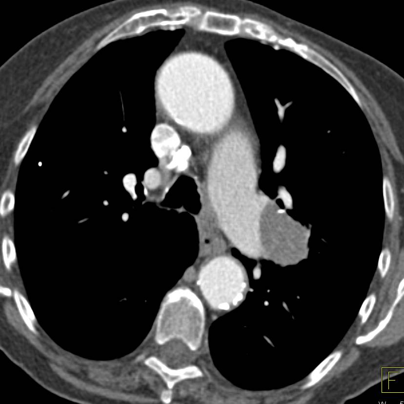 Chronic Pulmonary Embolism - CTisus CT Scan