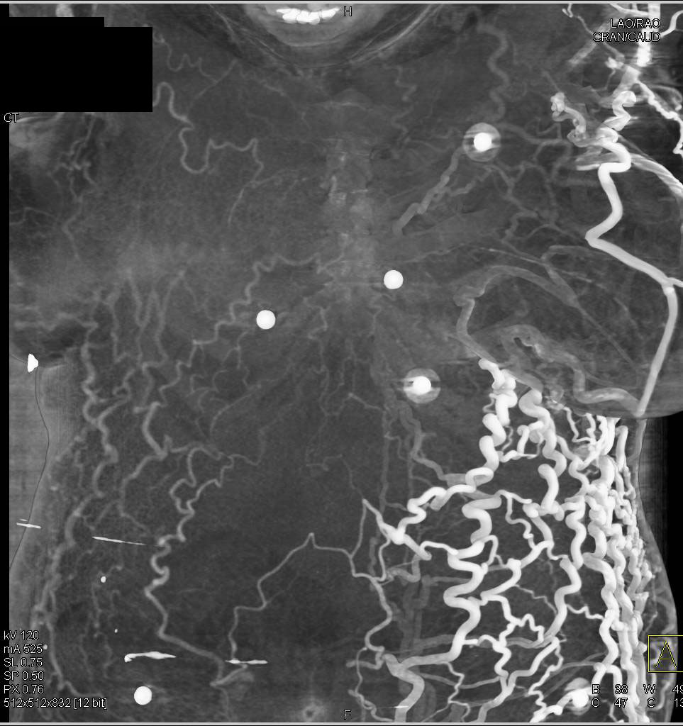 Superior Vena Cava (SVC) Stenosis with Extensive Collaterals - CTisus CT Scan
