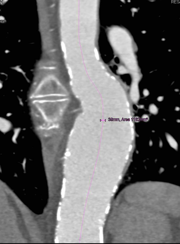 Aneurysm of the Descending Thoracic Aorta - CTisus CT Scan