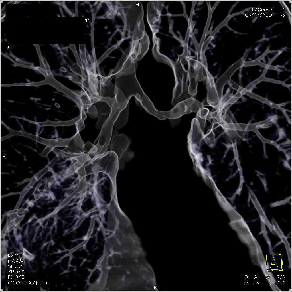 Narrowing of the Mainstem Bronchi in Wegener's Granulomatosis - CTisus CT Scan