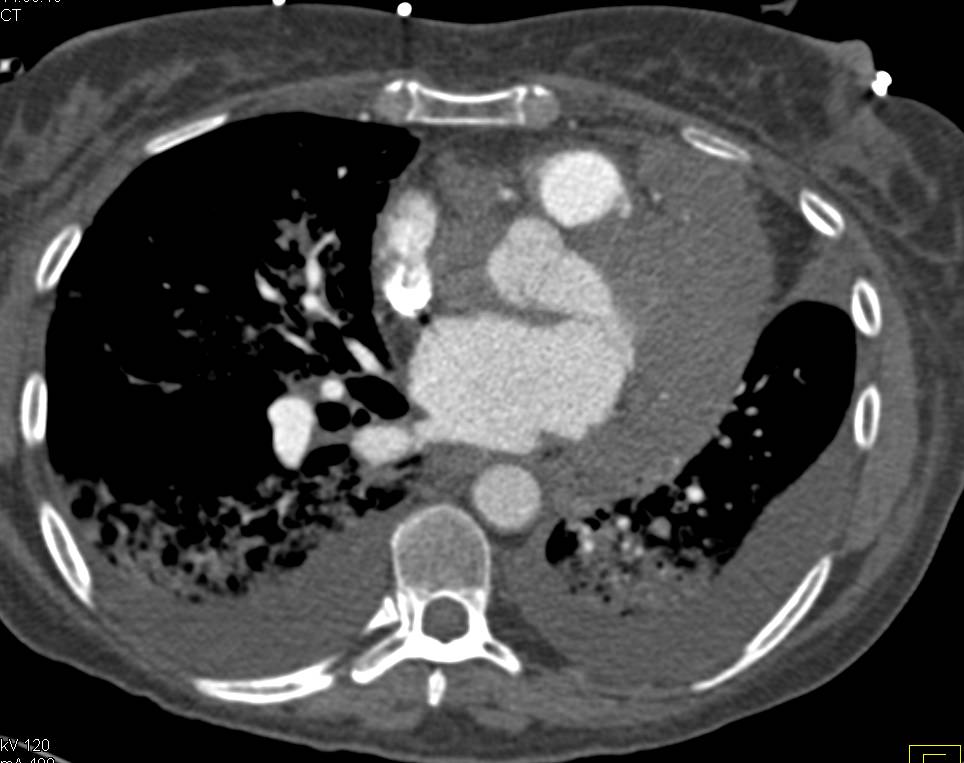 Non-Small Cell Lung Cancer (NSCLC) Encases the Left Main Pulmonary Artery and Invades the Pericardium - CTisus CT Scan