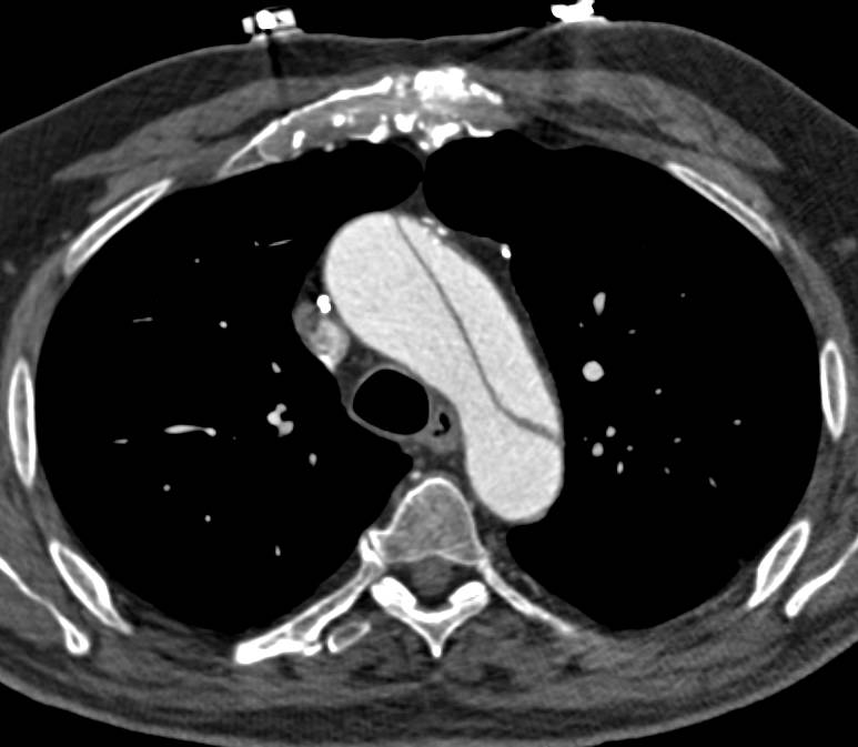 Type A Dissection - CTisus CT Scan