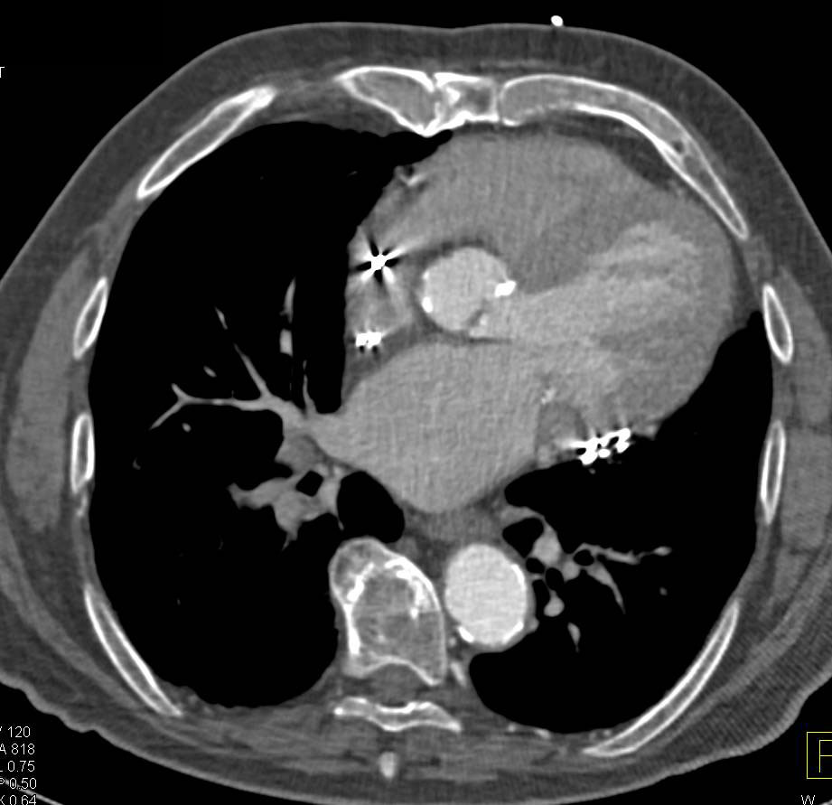 3D mapping of Bypass Grafts and Locations Prior to Redo Medial Sternotomy for Aortic Valve Replacement (AVR) - CTisus CT Scan