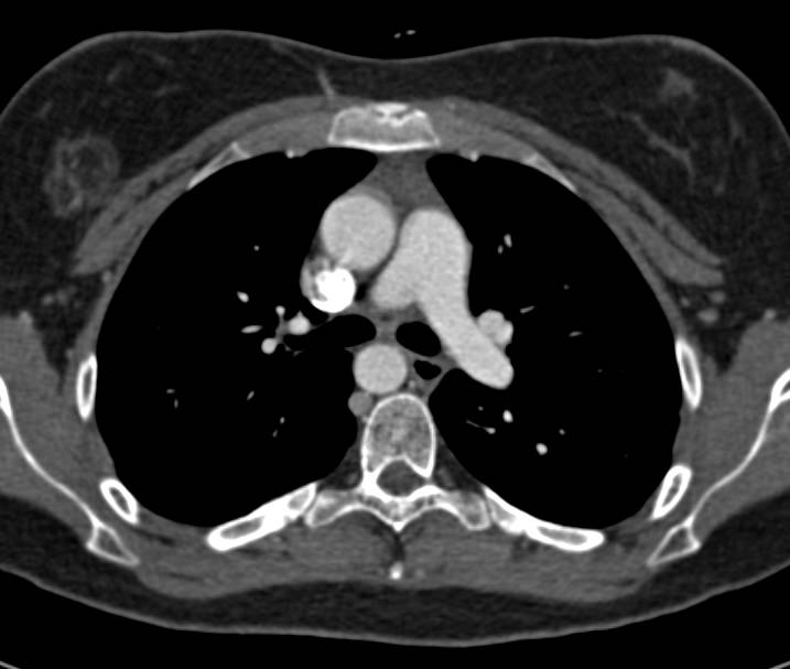 Right Aortic Arch with Aberrant Left Subclavian Artery - CTisus CT Scan