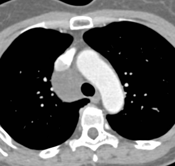 Bronchogenic Cyst - CTisus CT Scan