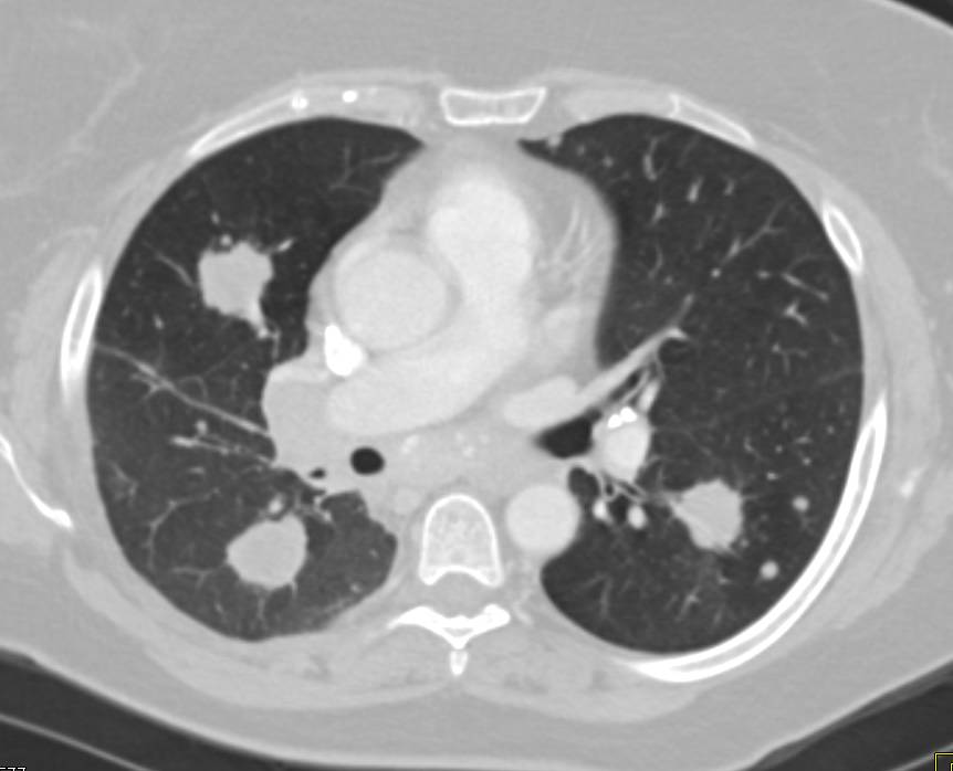 Metastatic Renal cell Carcinoma to Lung, Mediastinum and Spleen - Chest
