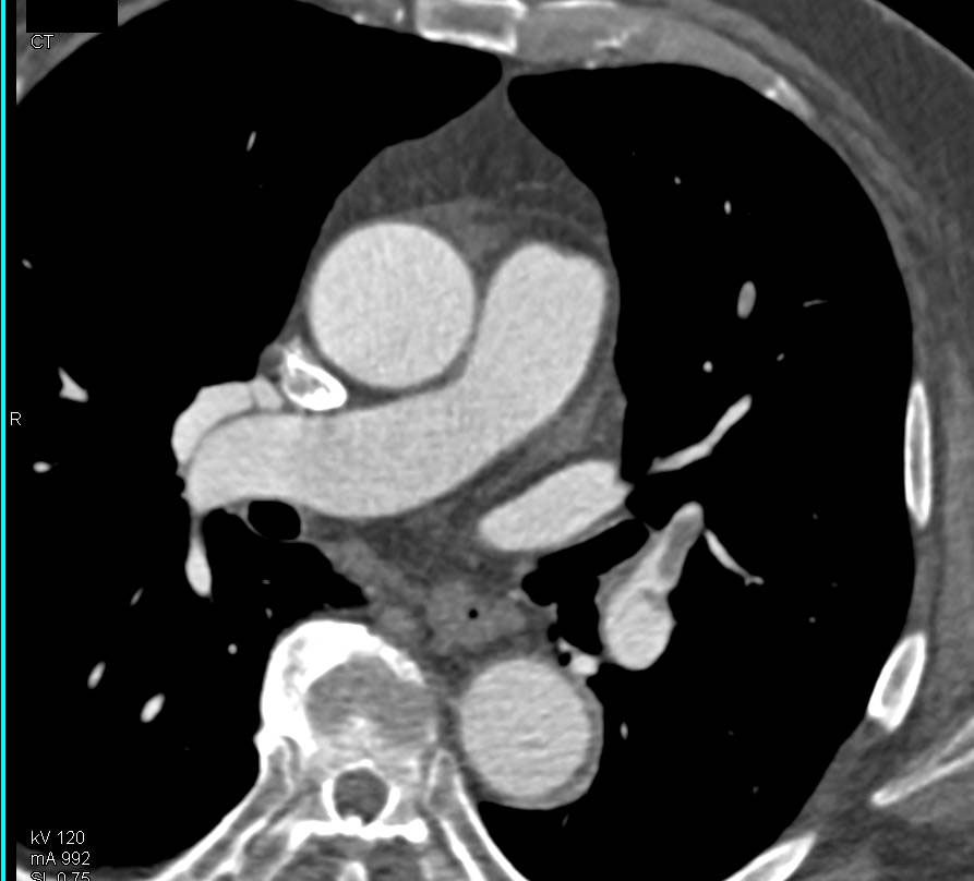 Multiple Bilateral Pulmonary Emboli - CTisus CT Scan