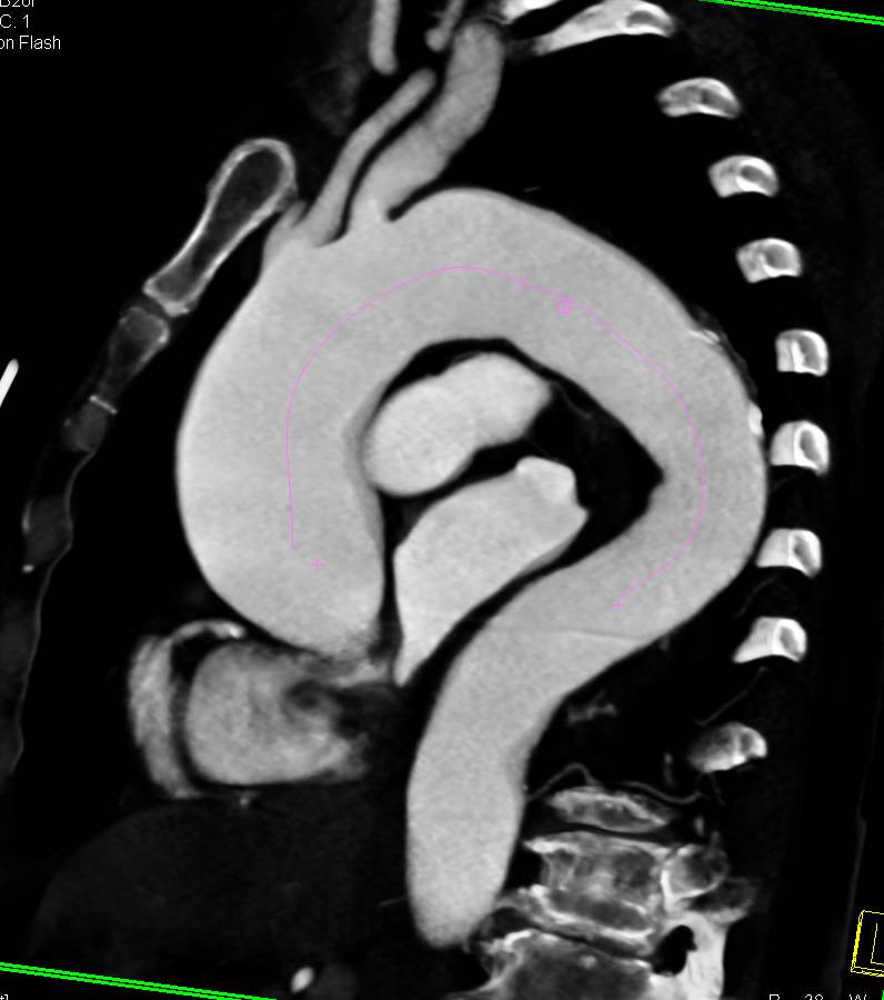 Dilated Ascending Aorta Analyzed with Vessel Tracking with Aberrant Right Subclavian Artery - CTisus CT Scan
