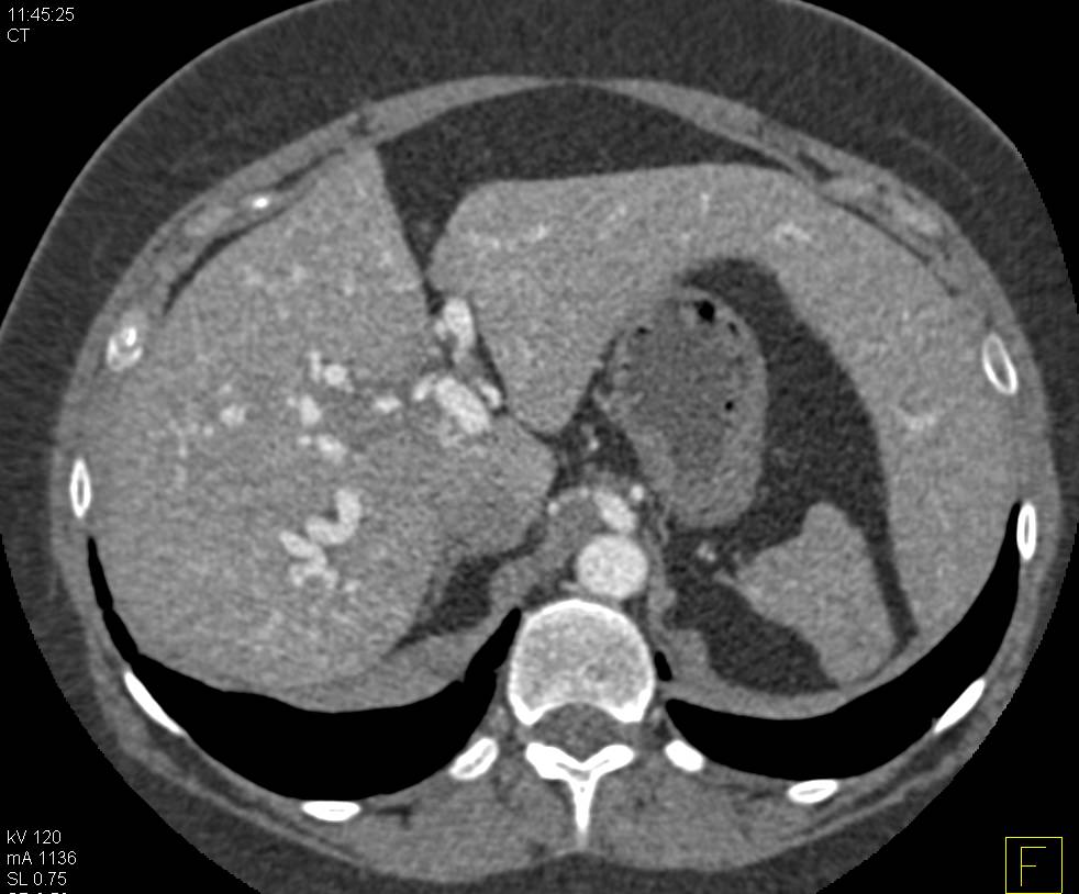 Hereditary Hemorrhagic Telangiectasia (HHT) with Pulmonary Arteriovenous Malformations (PAVMs) and Hepatic AVMs - CTisus CT Scan