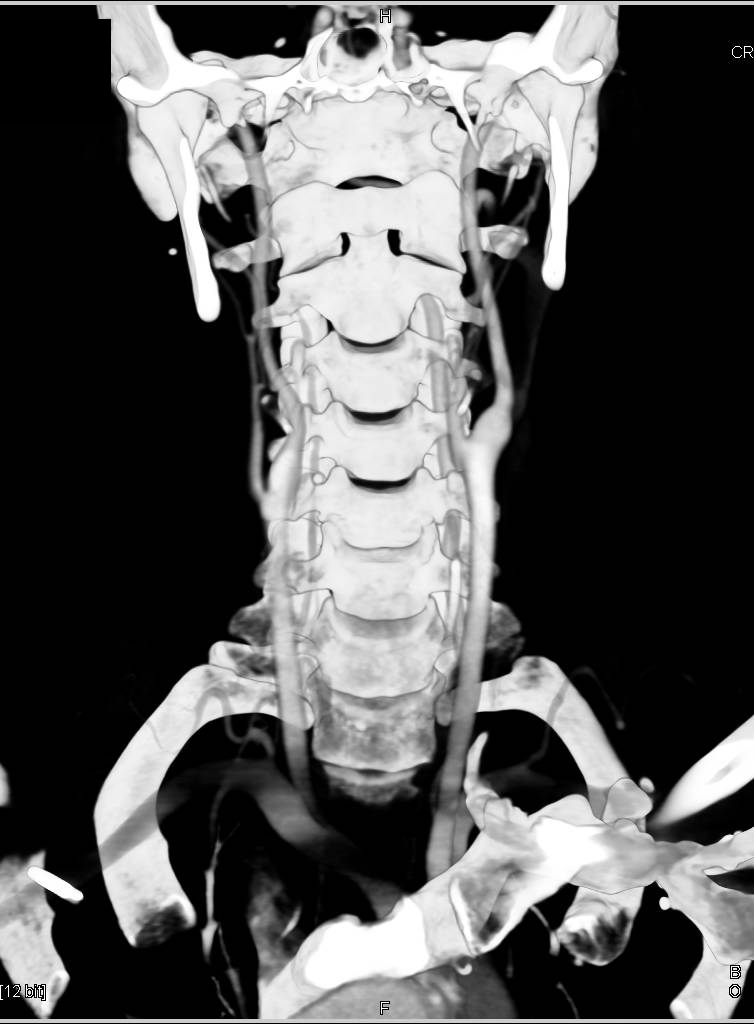 Type A Dissection with Repair and Dissection Past Repair Extends into Left Subclavian Artery and Patient also has Right Renal Artery Fibromuscular Dysplasia (FMD) - CTisus CT Scan