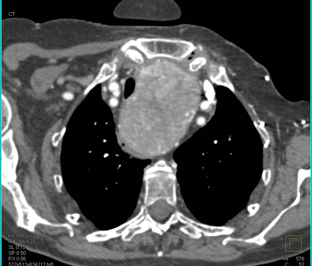 Substernal Thyroid Displaces the Trachea - CTisus CT Scan