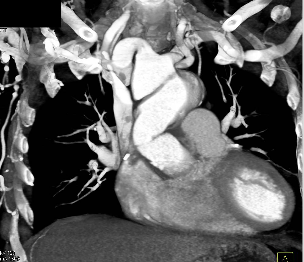 Aortic Root Repair with Aortic Valve Replacement (AVR) and Dissection Above the Repair Zone - CTisus CT Scan