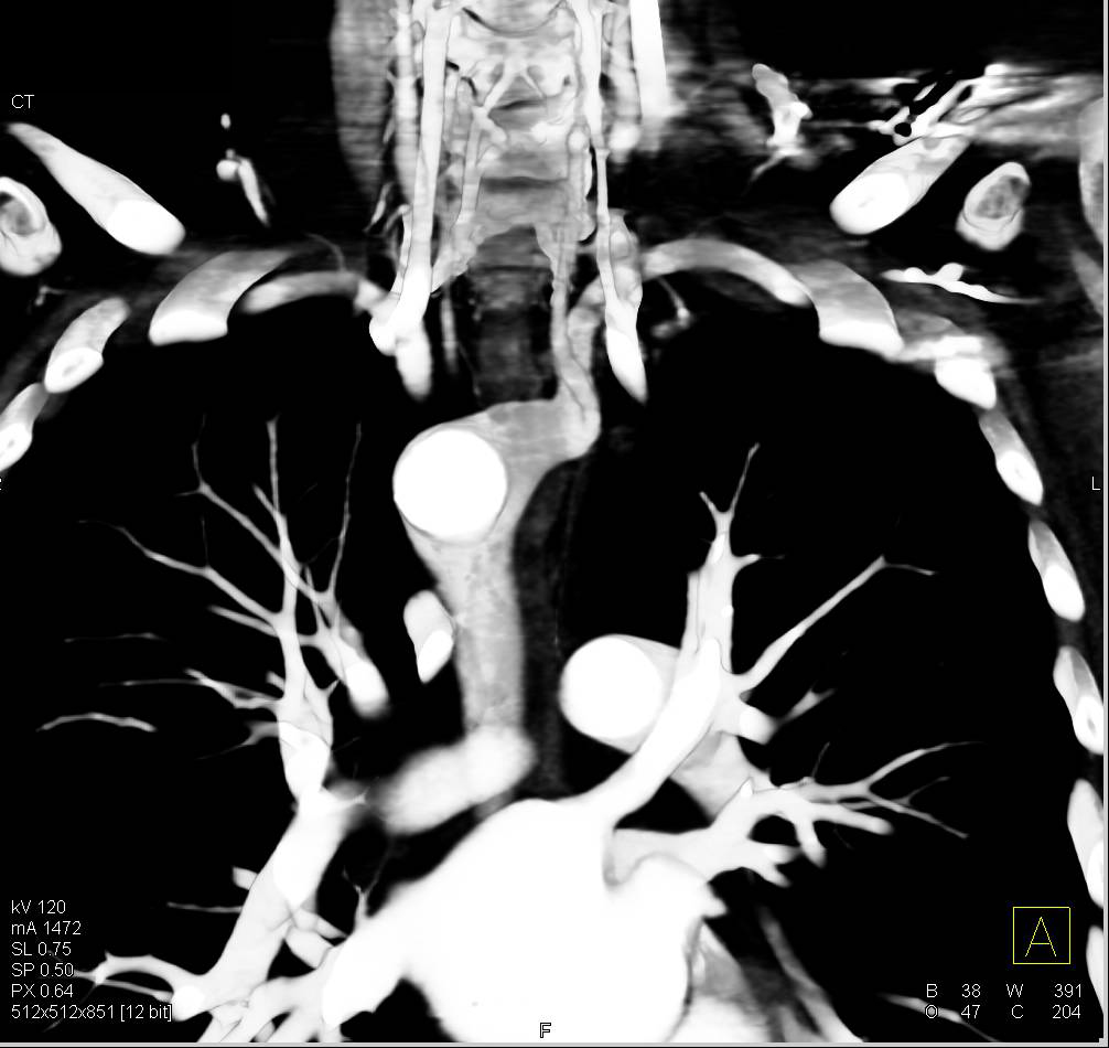 Right Sided Arch with Prominent Venous Drainage in the Mediastinum - CTisus CT Scan