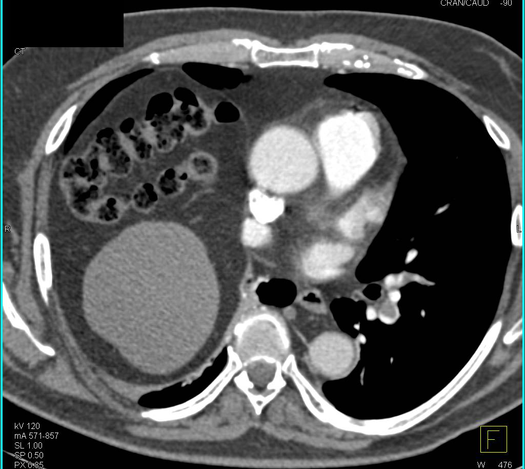 Extensive Right Pulmonary Embolism and Right Diaphragm Elevation - CTisus CT Scan