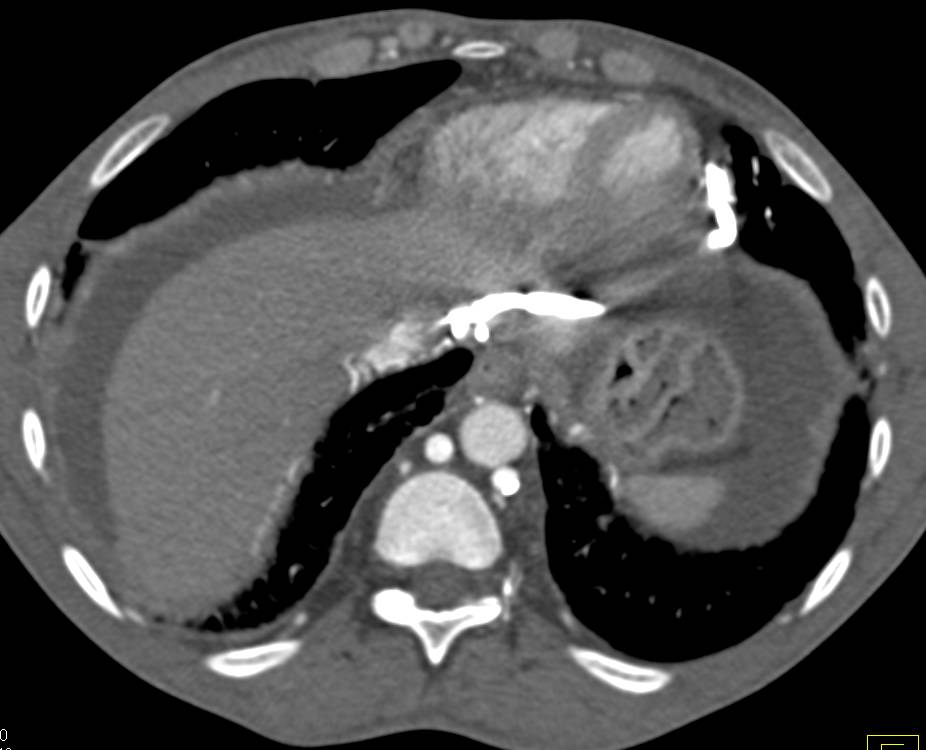 Superior Vena Cava (SVC) Occlusion with Impressive Collaterals Including Pericardial Collaterals - CTisus CT Scan