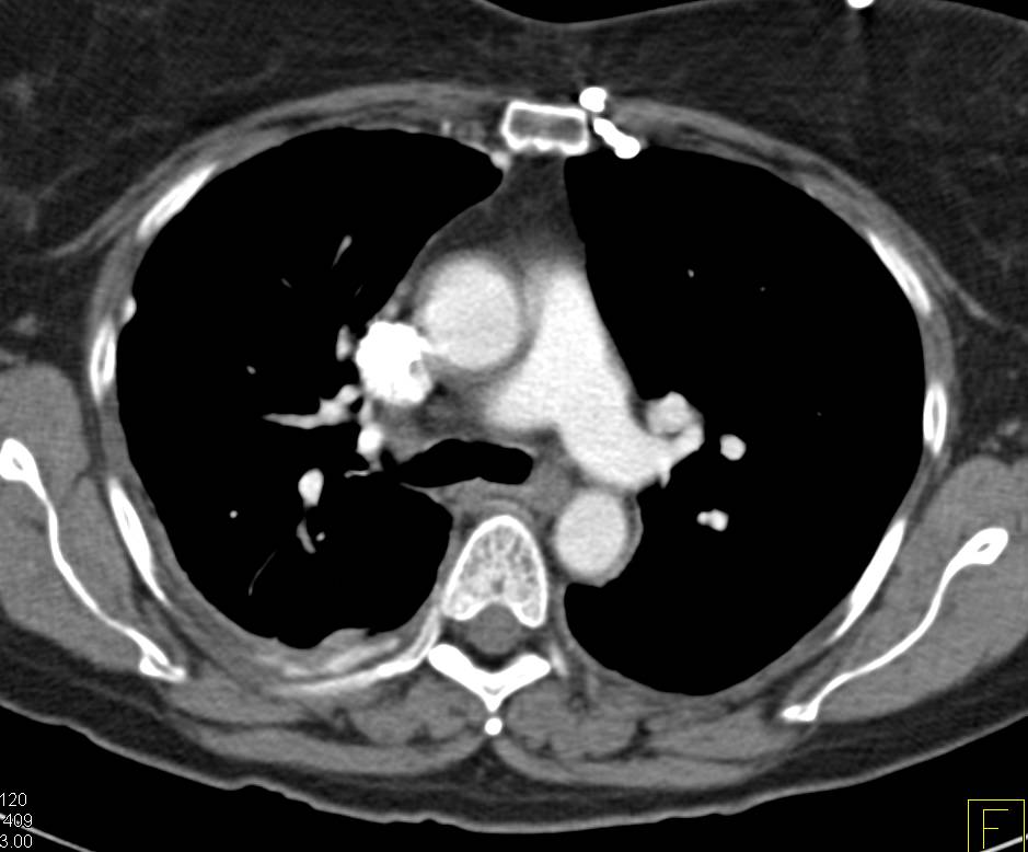 Pleural Inplants and Pleuradesis - CTisus CT Scan