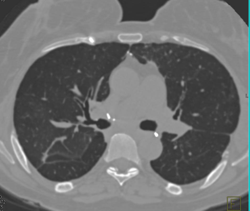 Post Transplant Lungs in 3D - CTisus CT Scan