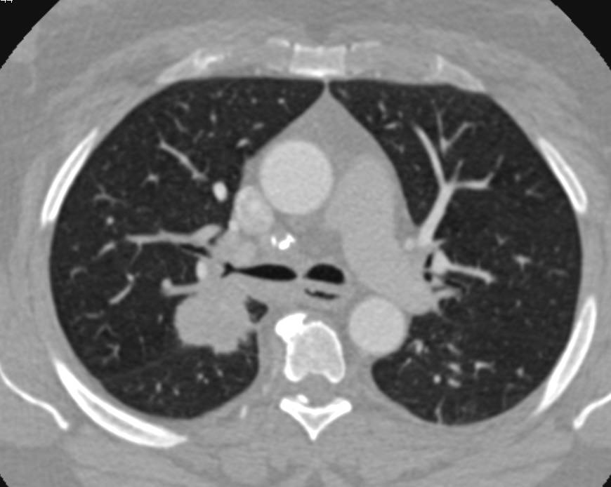 Metastatic Renal Cell Carcinoma to the Lung and Right Hilum - CTisus CT Scan