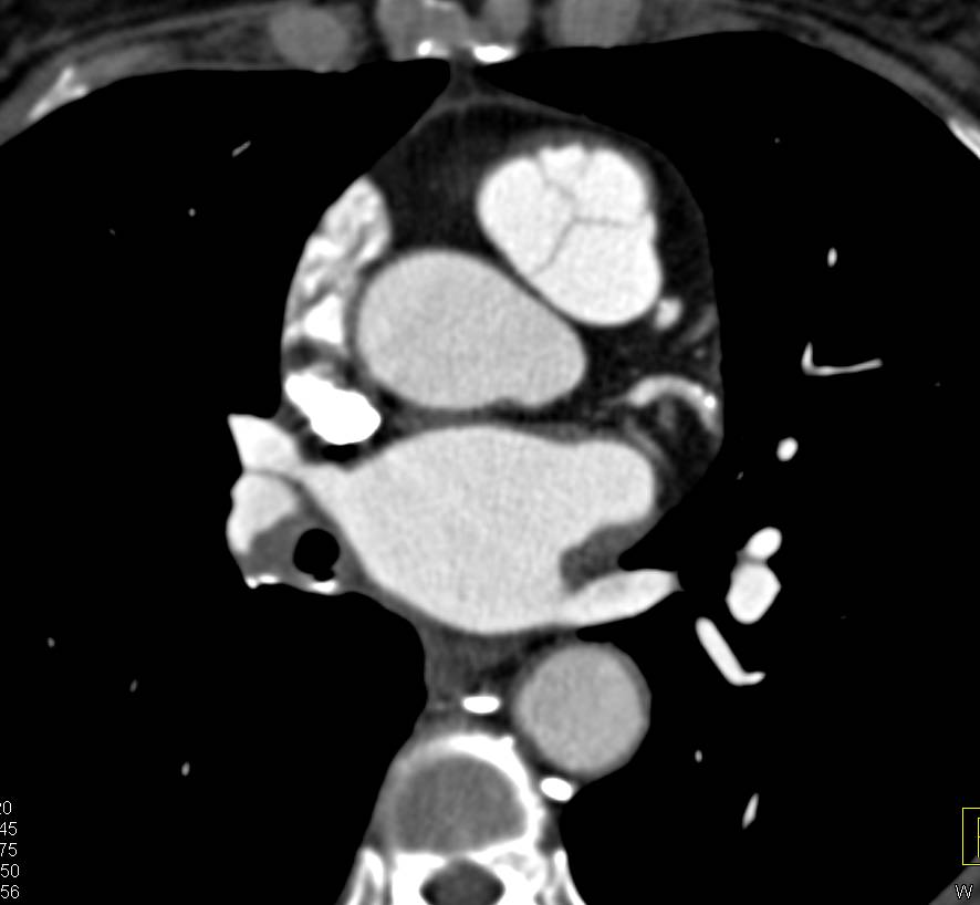 Chronic Pulmonary Embolism on the Right - CTisus CT Scan