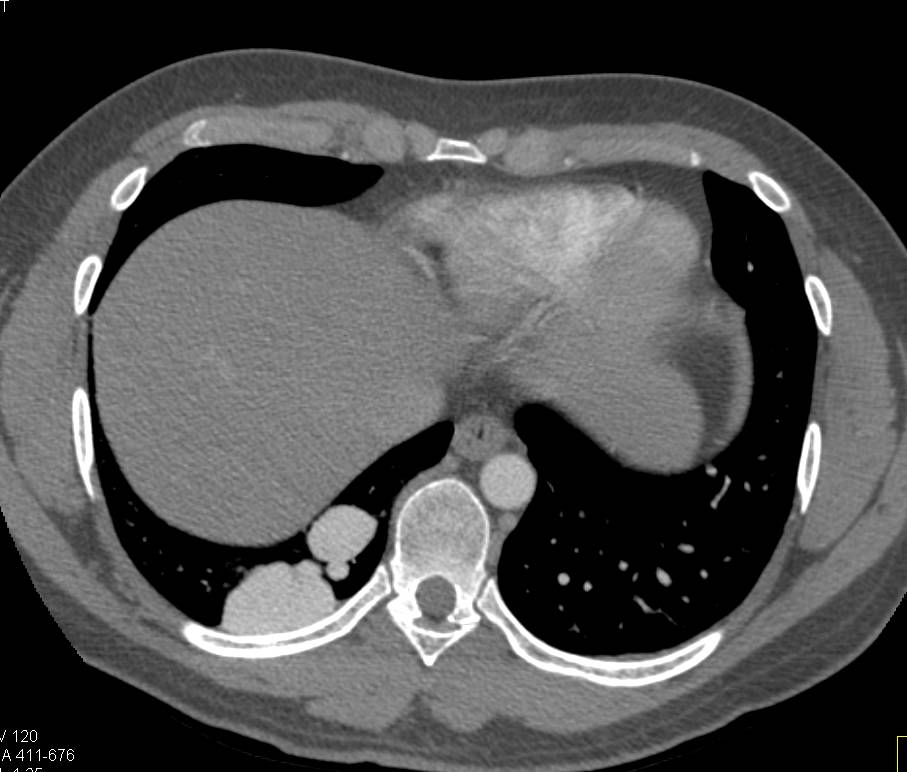 Large Right Pulmonary Arteriovenous Malformation (AVM) in 3D - CTisus CT Scan