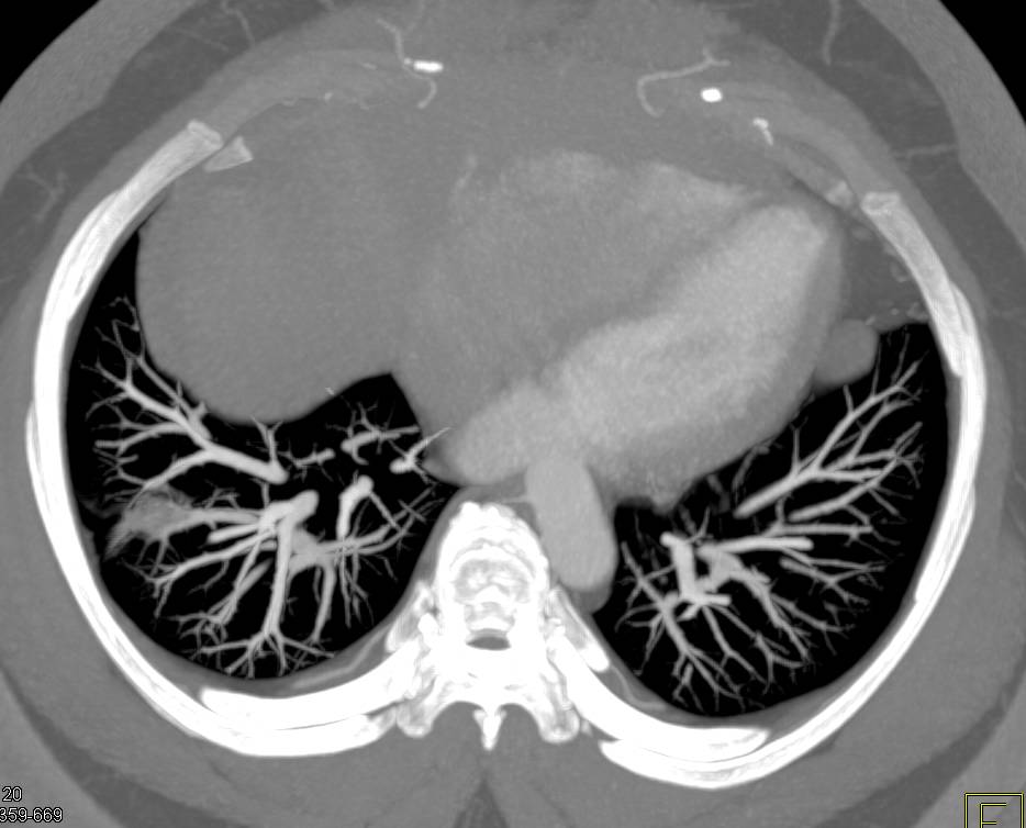 Bronchoalveolar Cell Carcinoma (BAC) Right Lower Lung - CTisus CT Scan