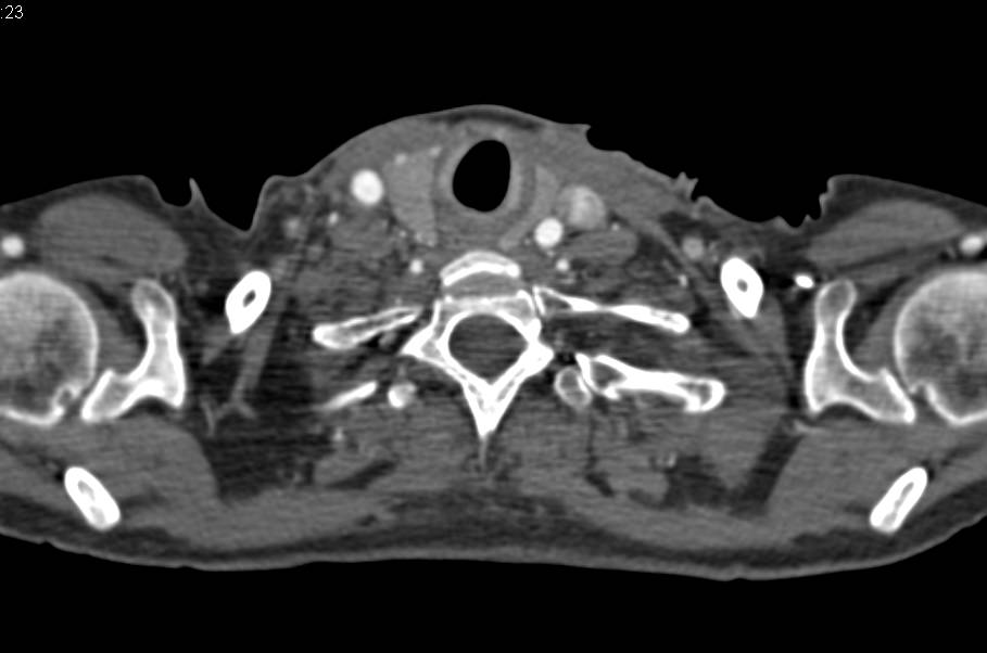 Superior Vena Cava (SVC) Occlusion Around an Indwelling Stent - CTisus CT Scan