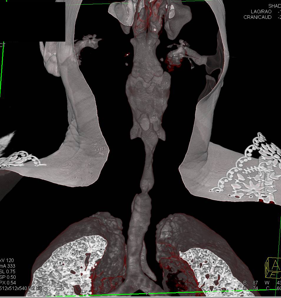 Tracheal Stenosis due to Prior Tracheostomy - CTisus CT Scan