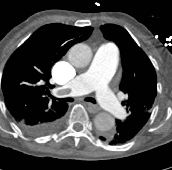 Pulmonary Embolism - CTisus CT Scan