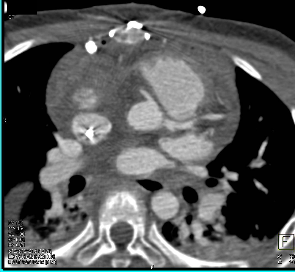 Post-Op Aortic Root Repair Without Pseudoaneurysm - CTisus CT Scan