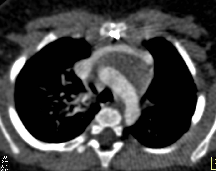 Dilated Main Pulmonary Arteries - CTisus CT Scan