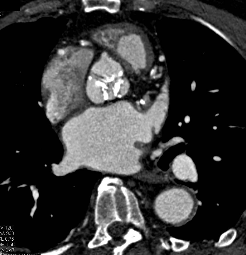 Extensie Aortic Valve Calcifications with Extensive Coronary Artery Disease - CTisus CT Scan