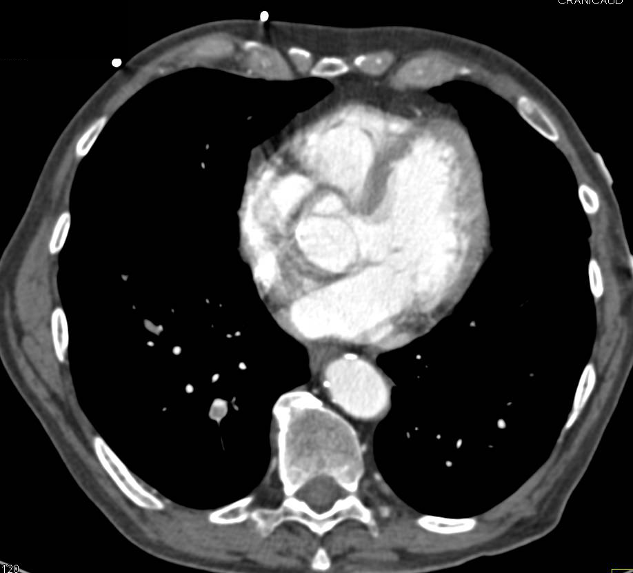 Incidental Pulmonary Embolism (PE) in a Patient with Metastatic Pancreatic Cancer at Presentation - CTisus CT Scan