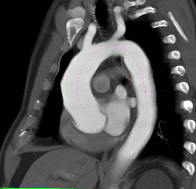 Dilated Aortic Root with Center Line Measurements - CTisus CT Scan