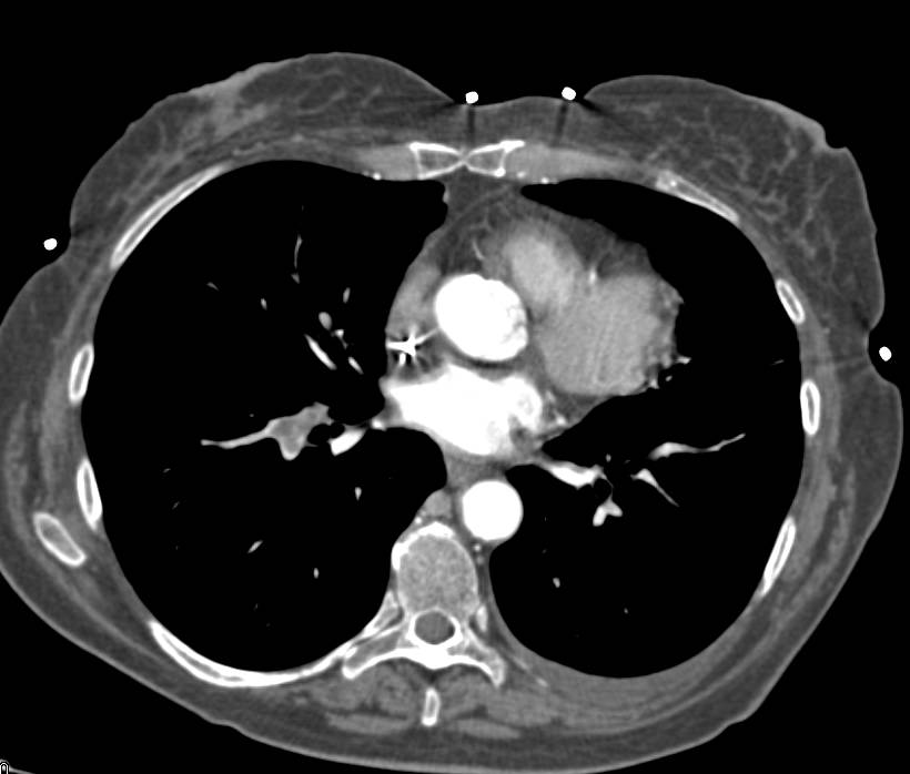 Incidental Pulmonary Embolism (PE) in a Patient with Metastatic Pancreatic Cancer - CTisus CT Scan