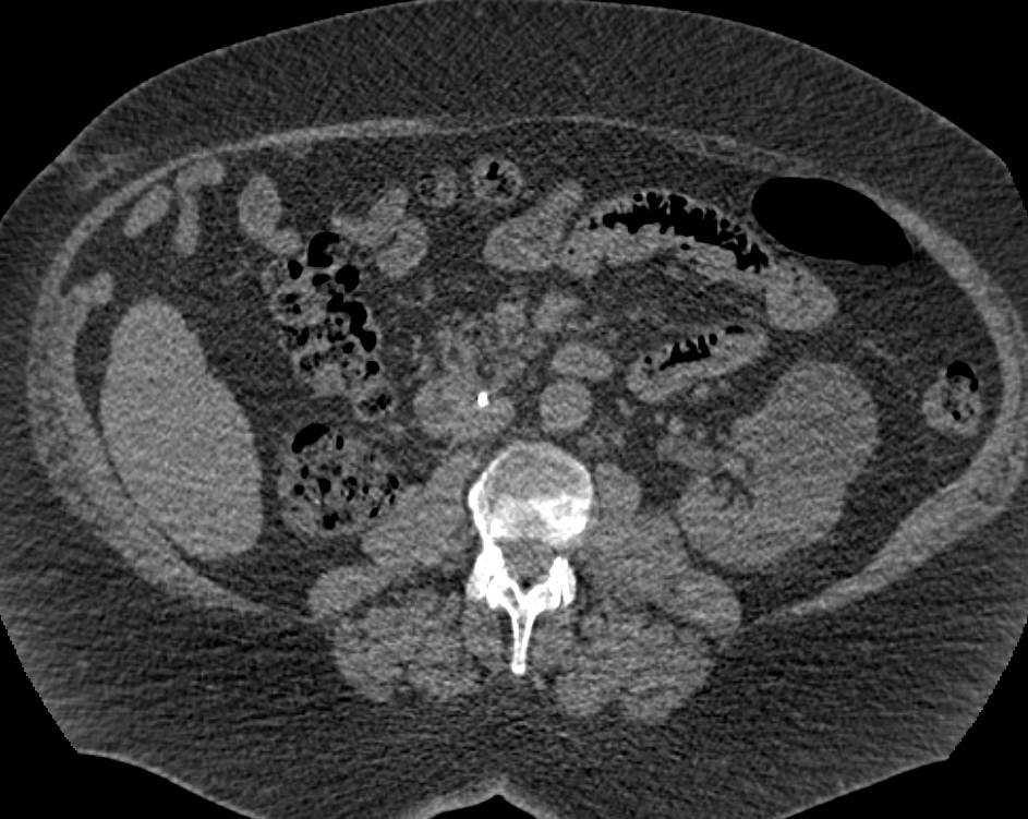 Incidental Pulmonary Embolism (PE) in a Patient with Inferior Vena Cava (IVC) Filter - CTisus CT Scan