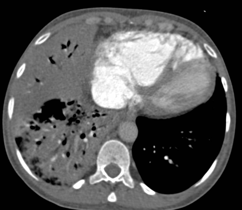 Hepatization of Right Lower Lung - Chest Case Studies - CTisus CT Scanning