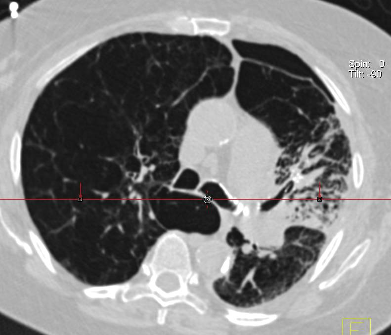 Bronchiectatic Changes with Endoluminal View - CTisus CT Scan