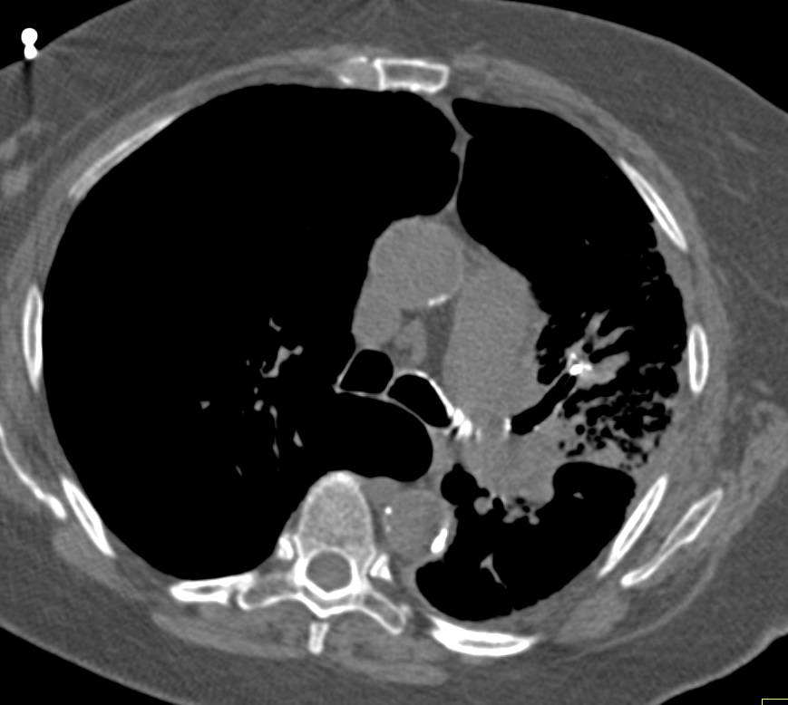 Bronchiectasis with Broncholith - Chest Case Studies - CTisus CT Scanning