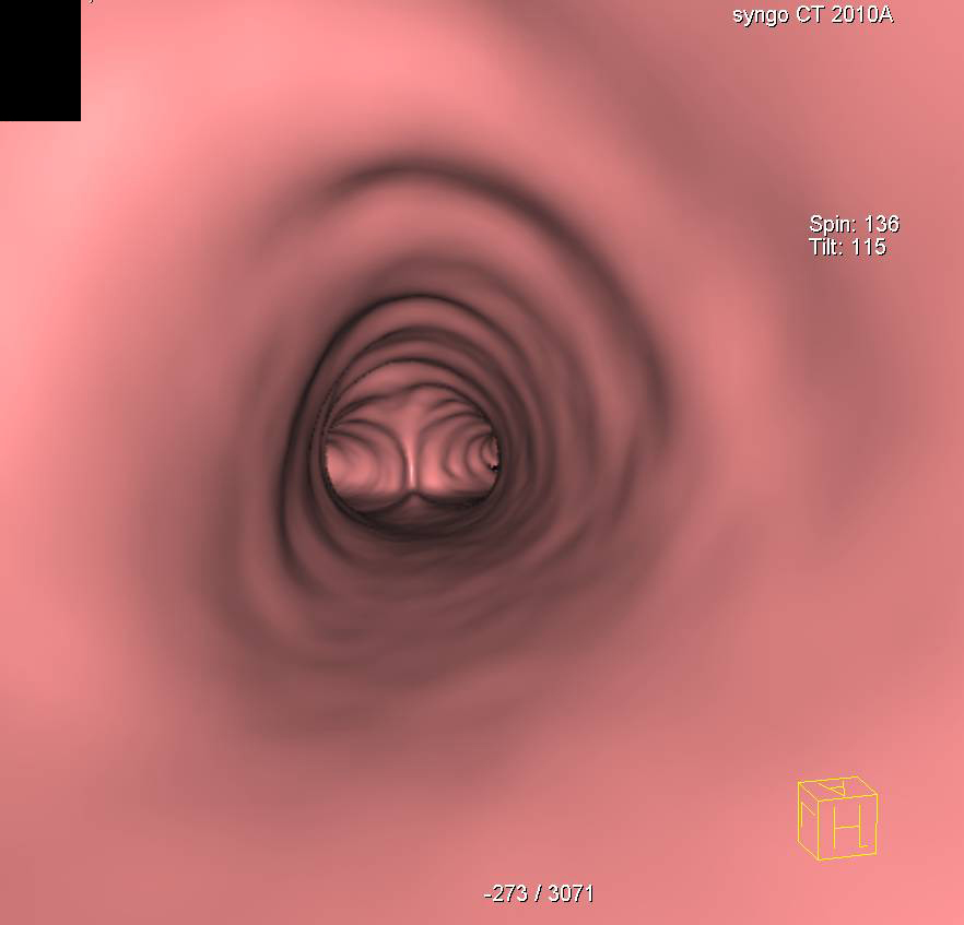 Virtual Bronchoscopy at Tracheal Bifurcation - CTisus CT Scan