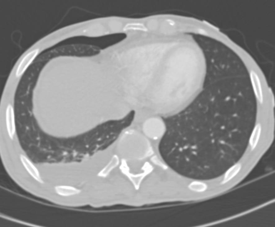 Pneumothorax as a Complication of Biliary Catheter Placement - CTisus CT Scan